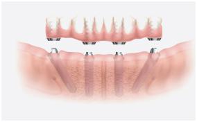 a full arch of teeth with 4 implants below them