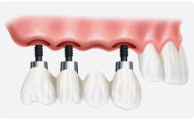 a bridge of teeth with 3 implants holding it up