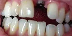 a front tooth implant with a tooth about to be placed onto the jaw