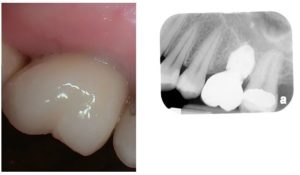 a person who received an immediate implant at durham implants solutions