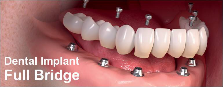 How to Find the Best Dental Implant Dentist?