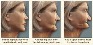 a person slowing losing their face shape from lack of teeth creating bone loss and collapsing the bite