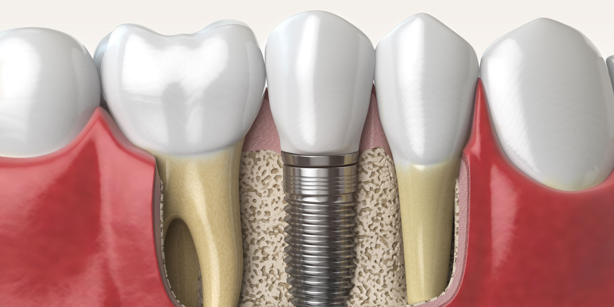 bone graft model Durham Dental Solutions
