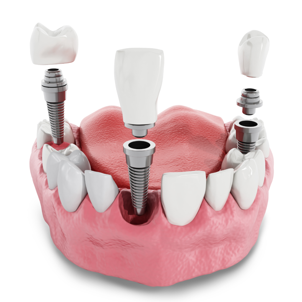 dental implant model Durham Dental Solutions