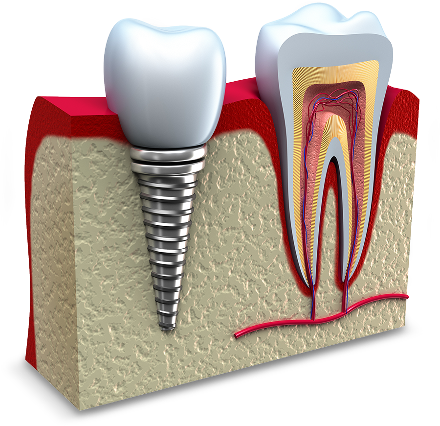 failing dental implant model Durham Dental Solutions