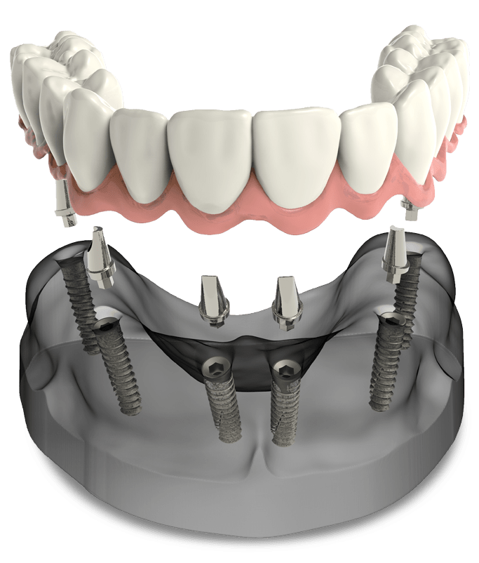 full arch dental implants model Durham Dental Solutions