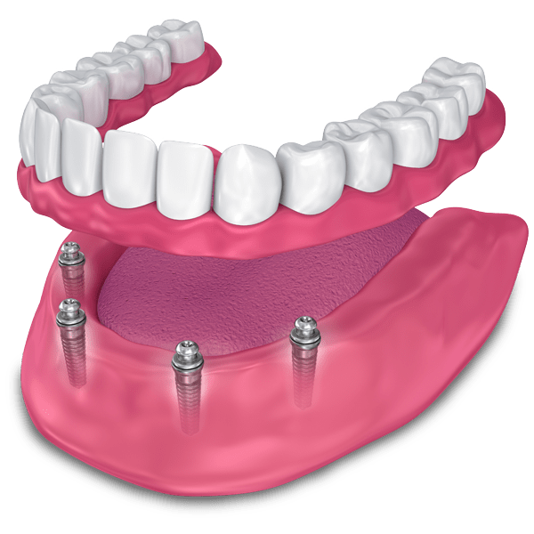 implant supported dentures model Durham Dental Solutions