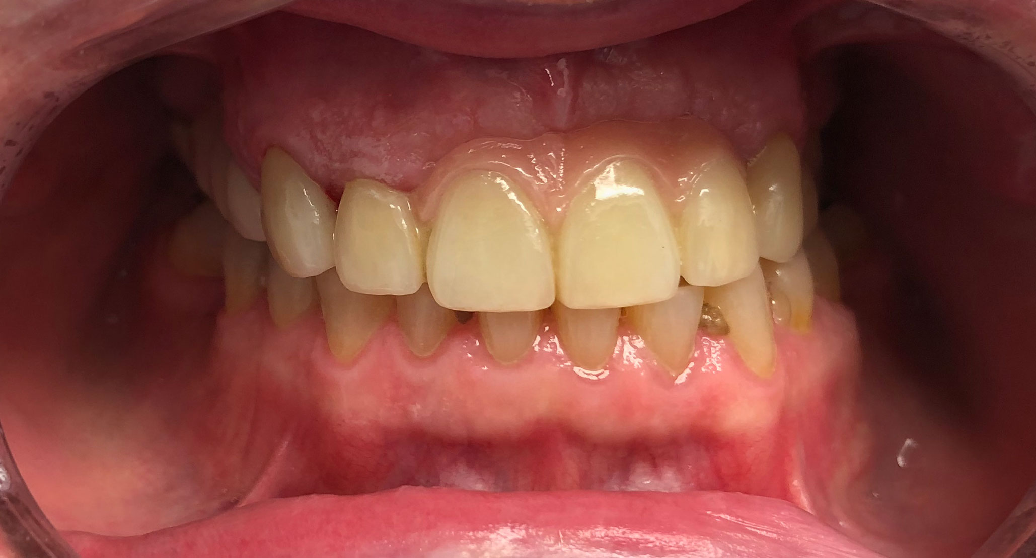 3 Dental Implants After Durham Dental Solutions