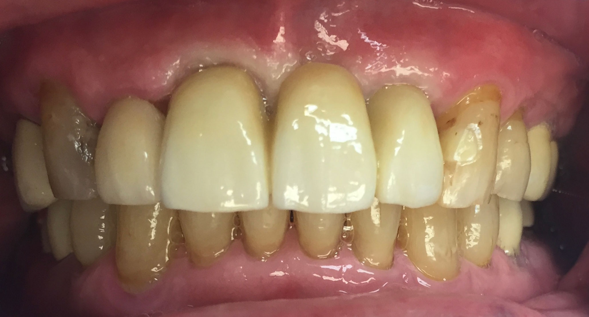 2 Dental Implants after Durham Dental Solutions