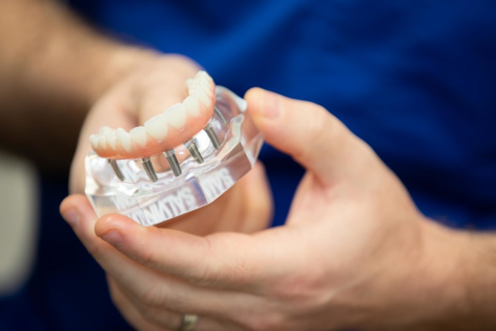 dental implant model Durham Dental Solutions
