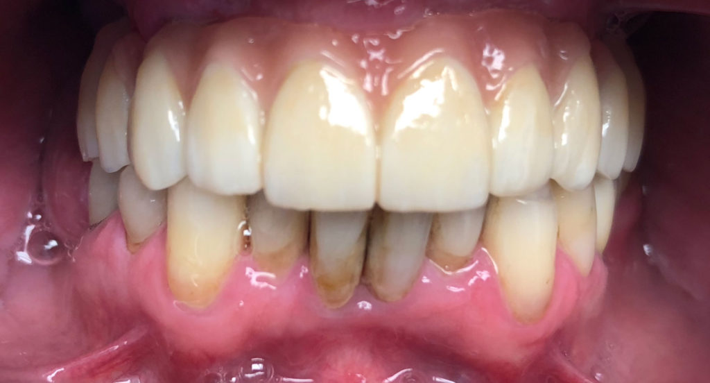 Full Arch Dental Implants Durham Dental Solutions