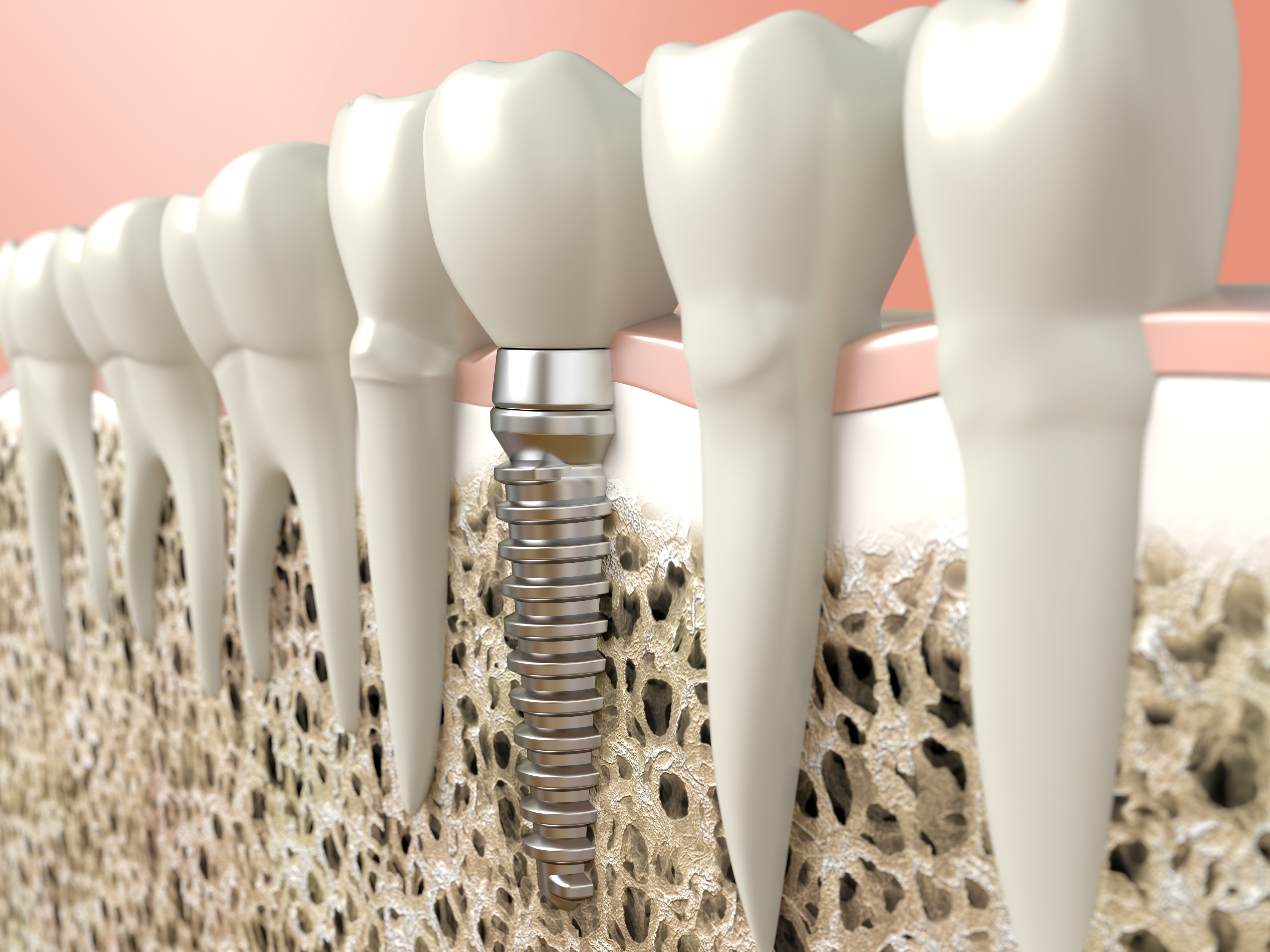Bone grafting Durham Dental Solutions