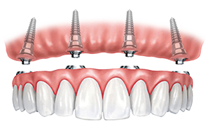TEETH IN A DAY