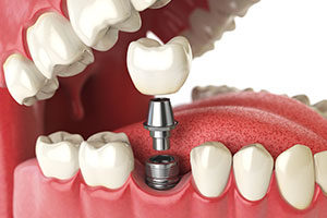 dental implants with a tooth on top