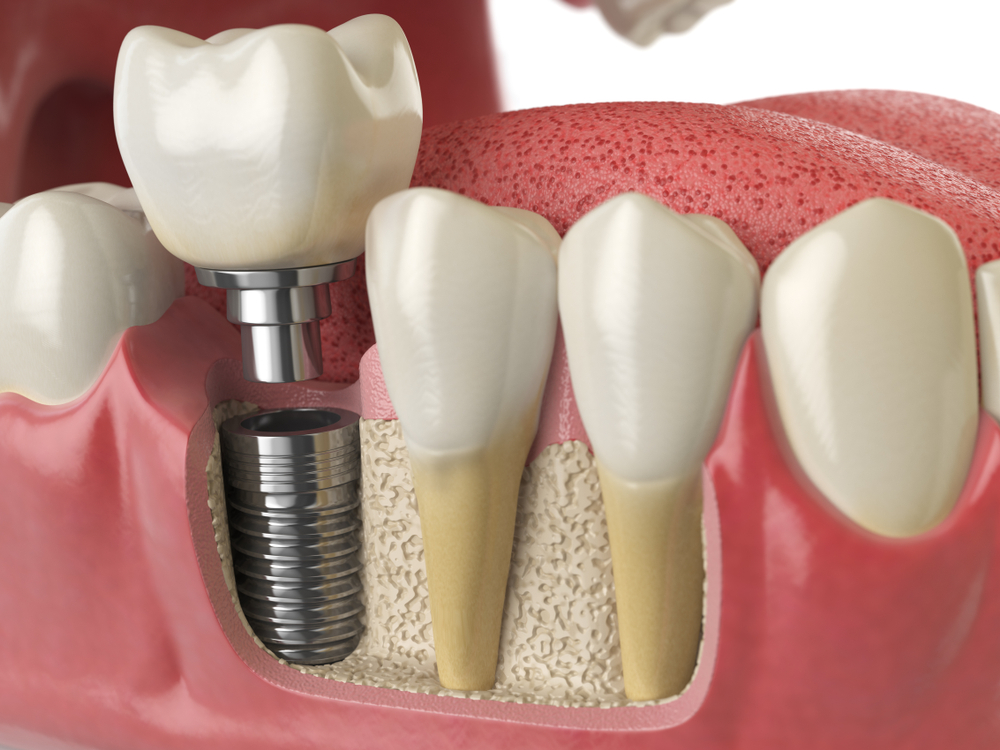 a cut away of the jaw with a dental implant