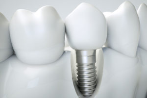 an implant thats placed into the jaw