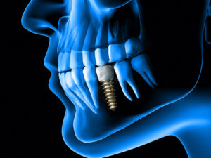 dental implants with an xray of the jaw