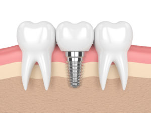 a single implant with 2 teeth being shown around it