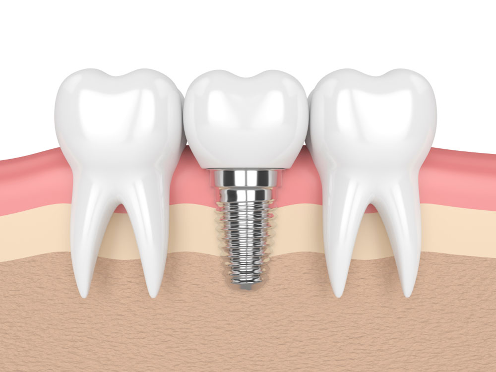 a single implant with 2 teeth being shown around it