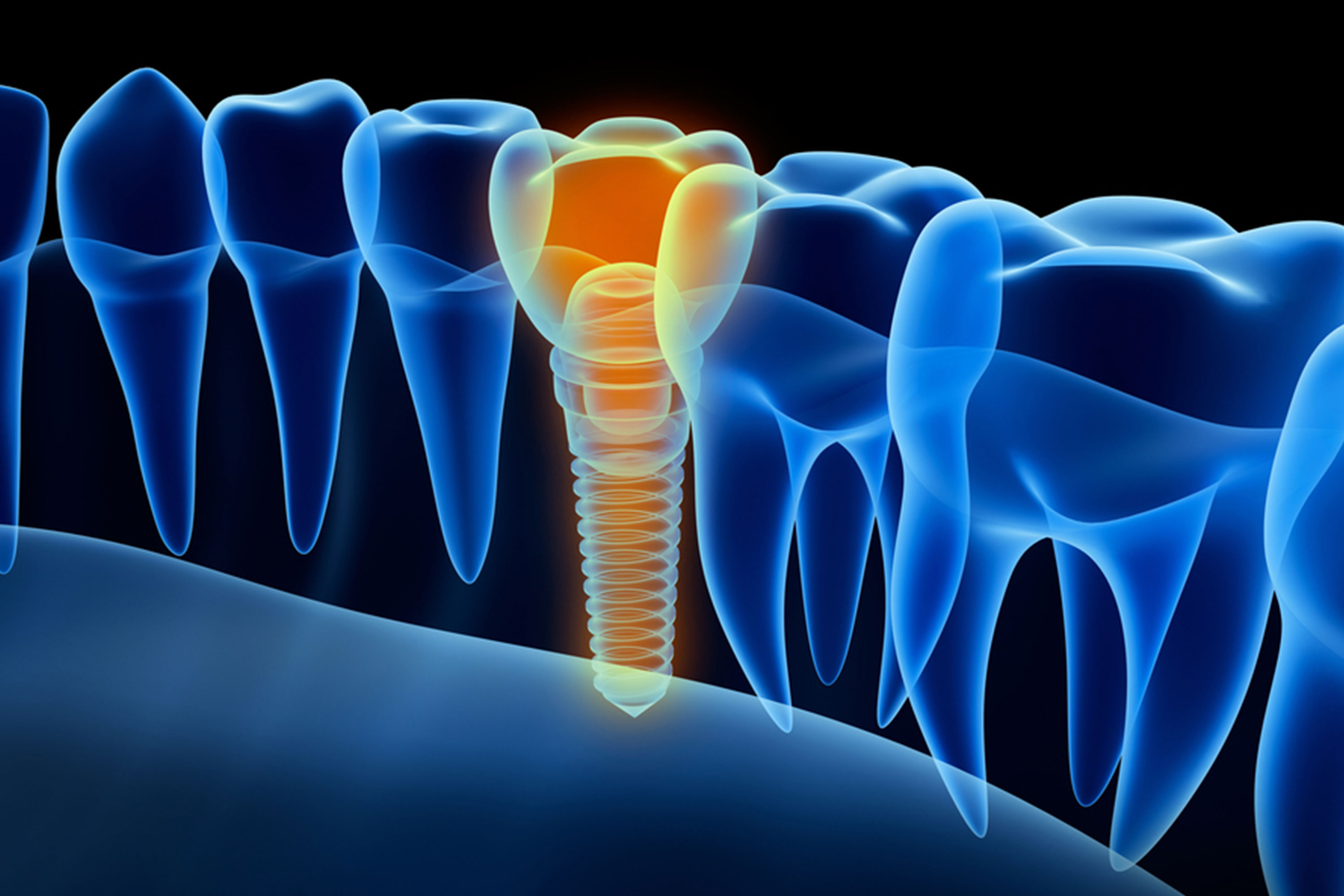 dental implants example