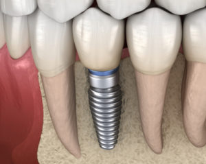 a small implant that was placed into the jaw