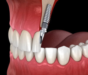 a dental implant diagram cutting the teeth in half to show how the implant interacts with the tooth