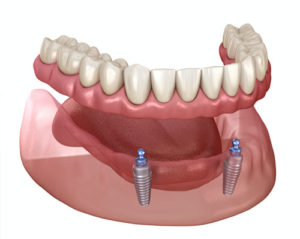 a full arch of denture implants with 2 implants placed into it