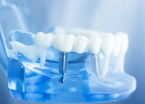 a see through dental implant model being shown with a set of teeth placed on top of them