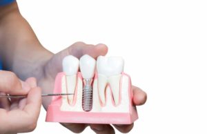 a dentist showing an implant cutaway with a dentist pointing a tool at the model
