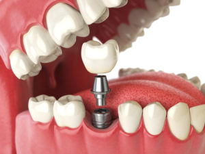 a dental implant diagram showing the layers of a dental implant