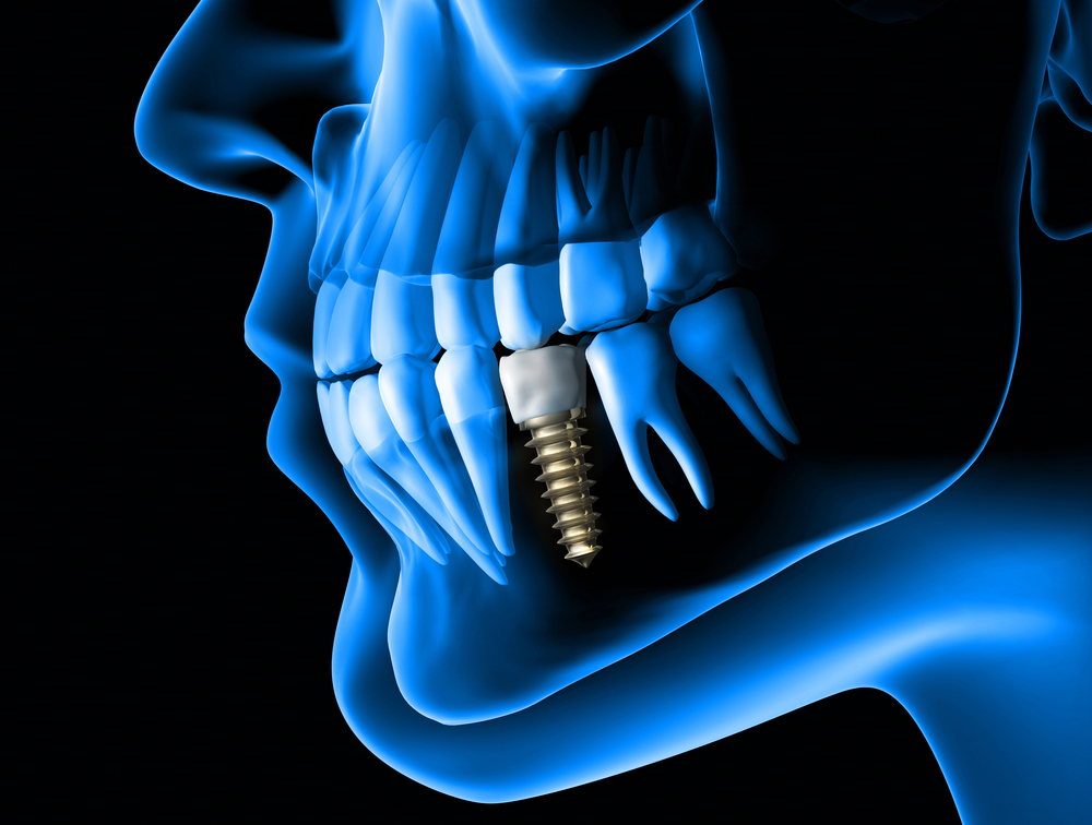 dental implant shown with an x-ray through the jaw