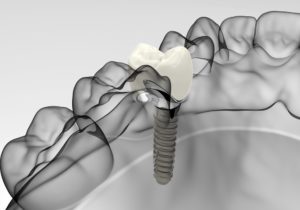 a dental implant banner showing the placement into the jaw