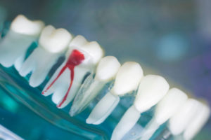 a root canal model being shown where you can see the root