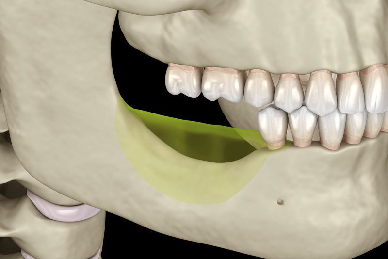 an illustration showing the loss of bone on the jaw from missing teeth