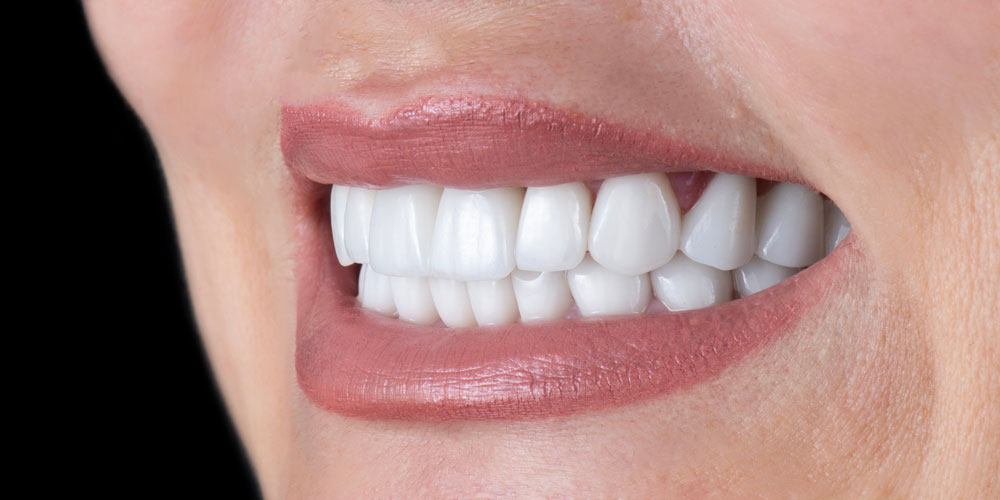 a patient with a full arch of dental implants