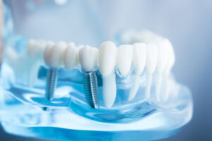 a dental implant model with 2 implants on one side