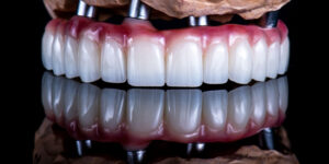 a full arch of dental implants with 4 implants being shown