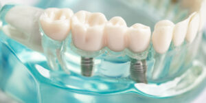 a see through dental implant model with 2 implants being shown