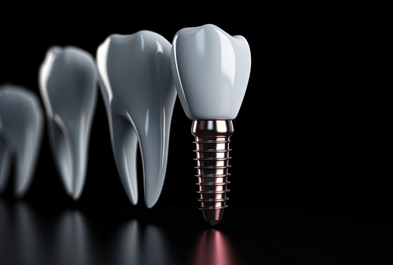 dental implant graphic
