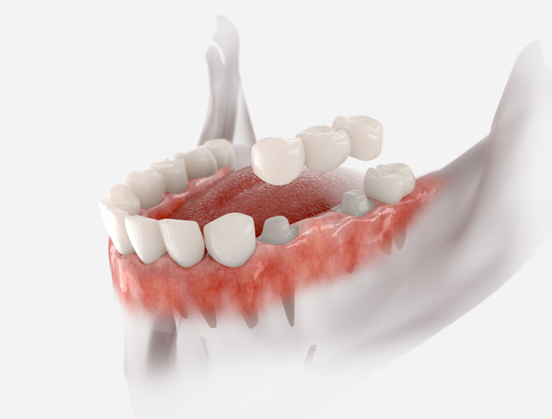 Bridge dental with 3 teeth fixed on molar and premolar.