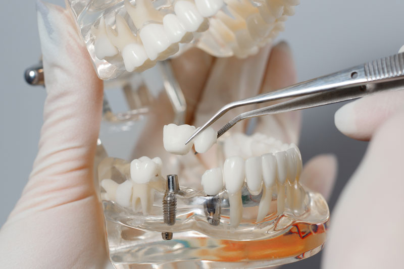 Close up photo of a professional mouth prosthesis model
