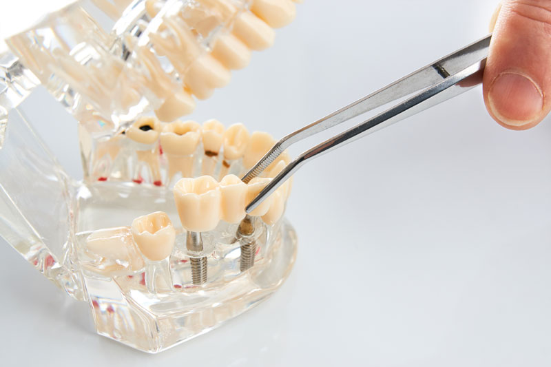 Dental technician placing the fixed partial denture, dental bridge on the screw implants, close-up.