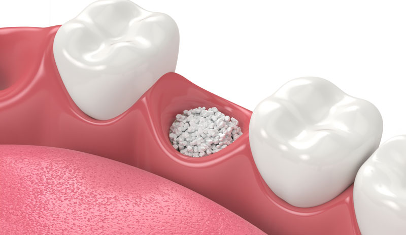 3D render of dental bone grafting with dental bone biomaterial over white background. Jaw bone augmentation procedure concept.