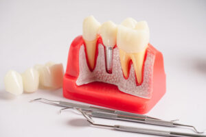 Dental implant, artificial tooth roots into jaw, root canal of dental treatment, gum disease, teeth model for dentist studying about dentistry.