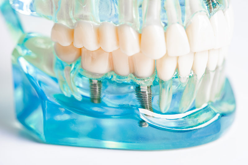 Dental implant, artificial tooth roots into jaw, root canal of dental treatment, gum disease, teeth model for dentist studying about dentistry.