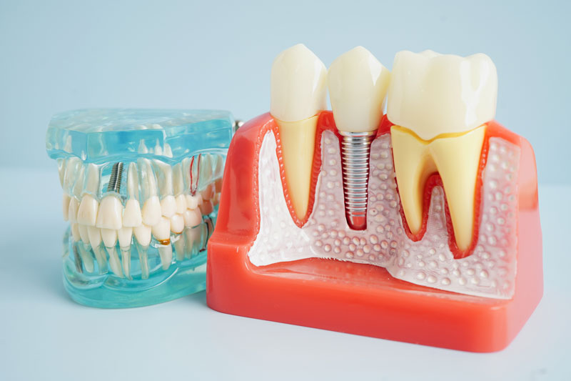 IMG META Dental implant, artificial tooth roots into jaw, root canal of dental treatment, gum disease, teeth model for dentist studying about dentistry.