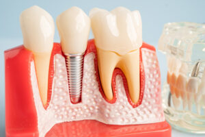 Dental implant, artificial tooth roots into jaw, root canal of dental treatment, gum disease, teeth model for dentist studying about dentistry