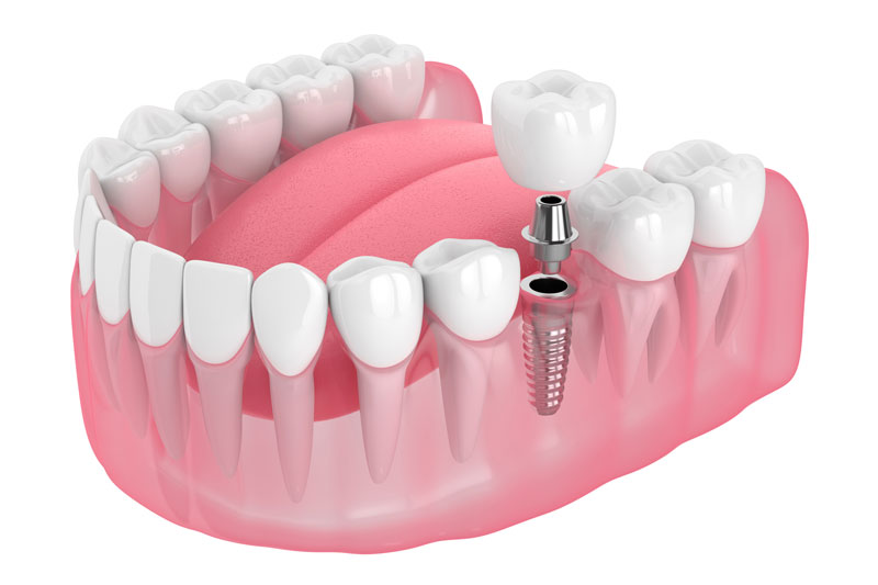 Single dental implant illustration showing a titanium implant in the jawbone supporting an abutment and a crown, replacing a missing tooth for natural function.