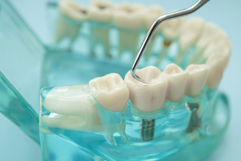 Close-up of a dental implant model with a dental probe touching a molar crown, showing implant placement and oral examination.