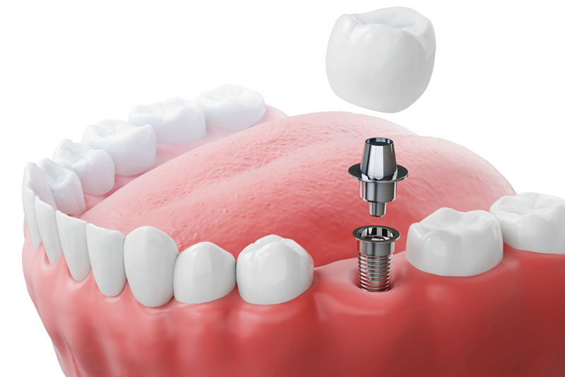 3D illustration of a dental implant with abutment and crown, showing how implants replace missing teeth for a stable, natural-looking restoration.